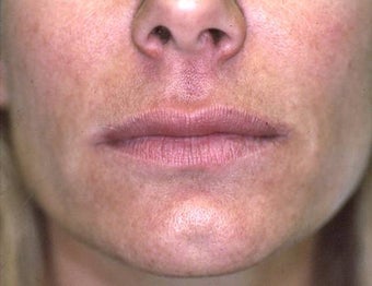 Lip Augmentation with Liquid Injectable Silicone after 157591