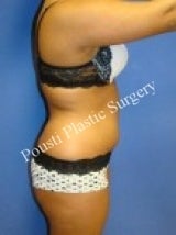 Liposuction 632168