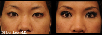 Asian Double Eyelid Surgery before 381166