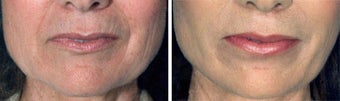 Chemical Peel before 652171