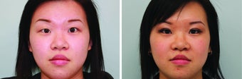 Double Eyelid Surgery Suture before 548933