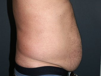 Body Liposculture 486600