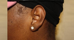 Earlobe Keloid 494466