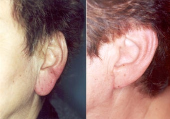 Lobularplasty before 314375