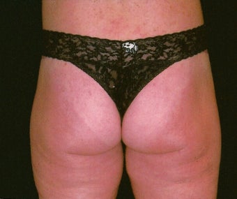 Buttock and flank lift for massive weight loss after 307428