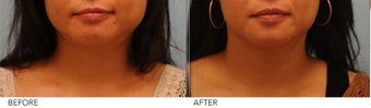 Botox Jaw Reduction before 269760