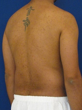 Vaser Hi Def Liposuction of the abdomen, chest, back, and flanks with fat injections to the pectoralis region 422700