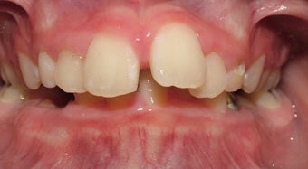 Teen Orthodontic Treatment (case #1JM) before 224715