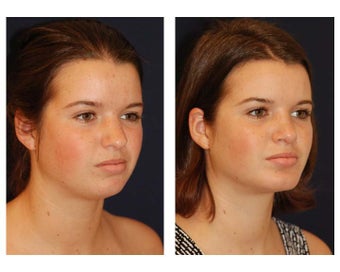 Chin Lipo after 346991