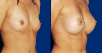 Breast Implants after 494485