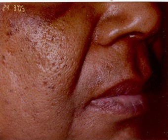 Restylane/Juvederm before 469313