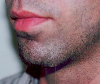Chin augmentation using prosthesis before 393547