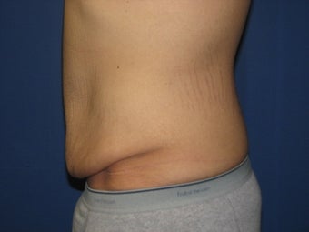 Male Tummy Tuck 576569