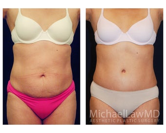 Tummy Tuck with Liposuction before 391605