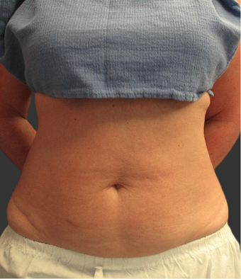 Exilis before 423765