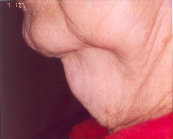 Lipodissolve and CoolSculpting before 429756