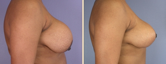 Breast Implant Removal before 270063