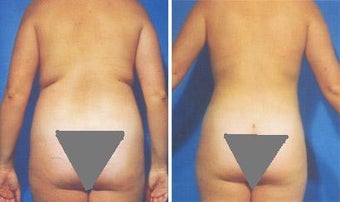 Liposuction before 636103