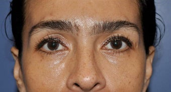 Lower lid blepharoplasty and Fat Transfer to lower lids and midface after 307123