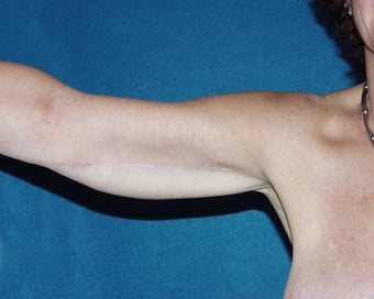 Brachioplasty after 118257