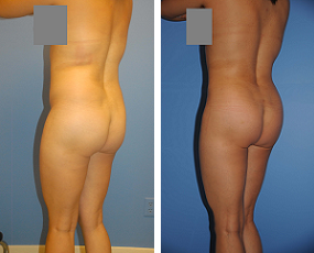 Buttocks Enhancement before 298399