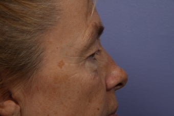 Eyelid Surgery before 324138