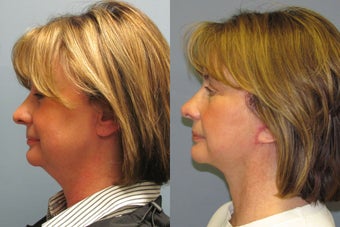 Lite Lift, liposuction of the neck before 523486