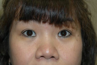 Asian eyelid surgery -- Double lid crease procedure before 341490