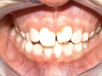 Upper Expander, Stunning Smile before 296521