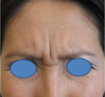 Botox before 83023