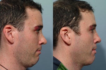 Revision rhinoplasty before 212610