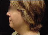 chin liposuction with platysmal plication (mini necklift) before 267584