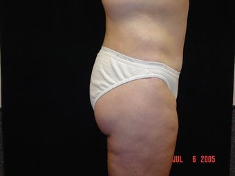 Body Lift with Liposuction of Abdomen, Waist, and Flanks after 203461