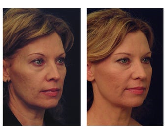 YAG Laser Skin Tightening after 490518