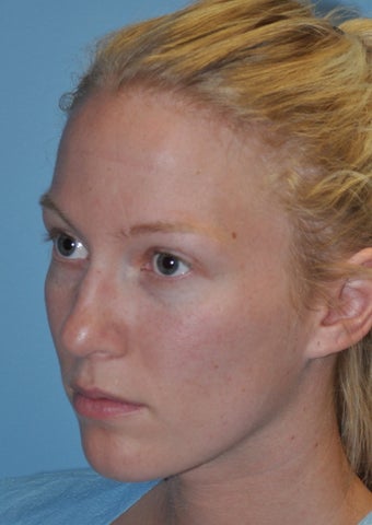 Rhinoplasty 373784