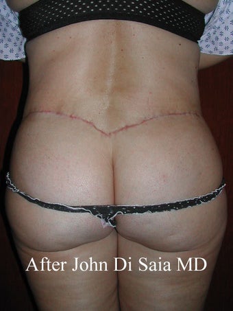 Butt Lift in a prior Tummy Tuck Patient after 100769