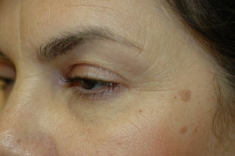 CO2 Laser resurfacing before 341479