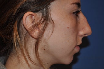 Chin Augmentation with Rhinoplasty before 582528