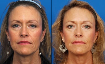 Ultherapy before 411573