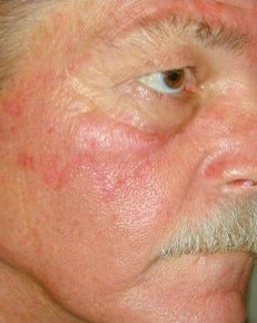 PDT for rosacea before 376139