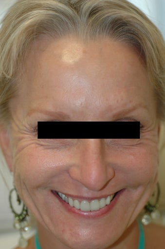 Dysport Injections Before and After Photos before 438319