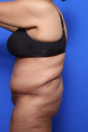Body Lift with Panniculectomy after 623706