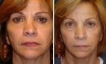 Non Surgical Rhinoplasty before 588459