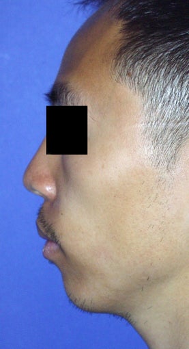 Chin Augmentation before 365454