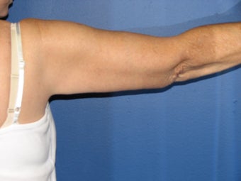 Brachioplasty 575818