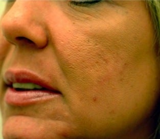 Acne treatment after 376128