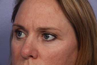 Eyelid Surgery after 306448