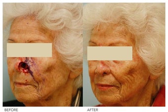 Facial Reconstruction after 136836