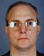 Hair Transplant before 426686