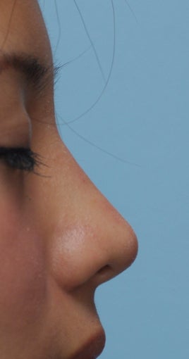 Non Surgical Rhinoplasty after 393833